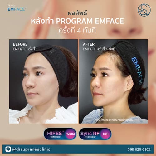 ผลลัพธ์ก่อนและหลังทำโปรแกรม EMFACE บริเวณหน้าผากและแก้ม ครบ 4 ครั้ง ที่ DR. SUPRANEE CLINIC ทองหล่อ