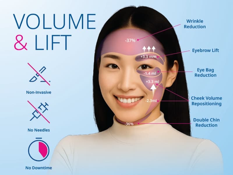 ผลลัพธ์ด้าน Volume และ Lift จากโปรแกรม EMFACE ลดริ้วรอย ยกคิ้ว ลดถุงใต้ตา เพิ่มวอลุ่มแก้ม และลดไขมันใต้คาง